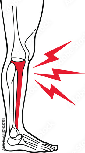 Illustration of a leg with shin splints, , pain