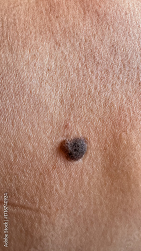  Close-up macro photograph of a pigmented skin mole or wart on human body. Medical and dermatological concept, useful for healthcare, education, dermatology clinic materials