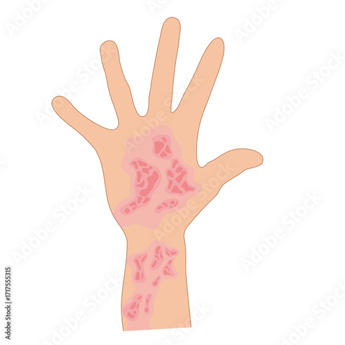 Dermantitis Illustration Element. Illustration of a hand affected by allergies. Flat design illustration of a sick hand. Illustration of a hand with red bumps due to allergie