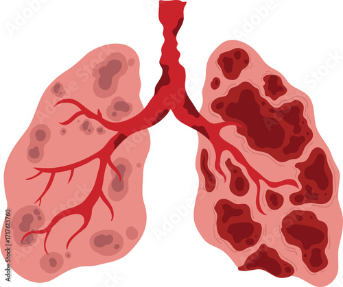 Lungs with diseased areas, pulmonary pathology illustration