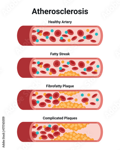 Type of cholesterol in human blood vessels. Low-Density Lipoprotein LDL. High-Density Lipoprotein HDL. Normal artery, blocked vascular, fatty streak, plaque, Moderate. Medical Vector illustration.

