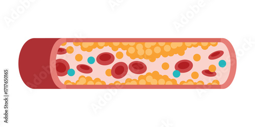 Type of cholesterol in human blood vessels. Low-Density Lipoprotein LDL. High-Density Lipoprotein HDL. Normal artery, blocked vascular, fatty streak, plaque, Moderate. Medical Vector illustration.