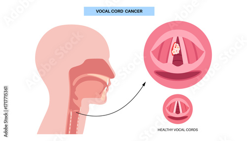 Vocal cord cancer medical poster