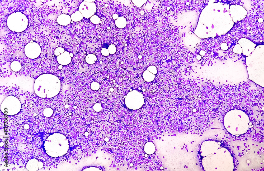Photography Bone marrow study: Plasma cell dyscrasia