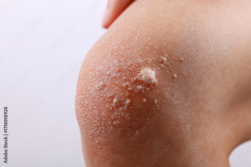Fototapeta premium Close-up of a person's knee with rough, flaky skin and a whitish, bumpy area