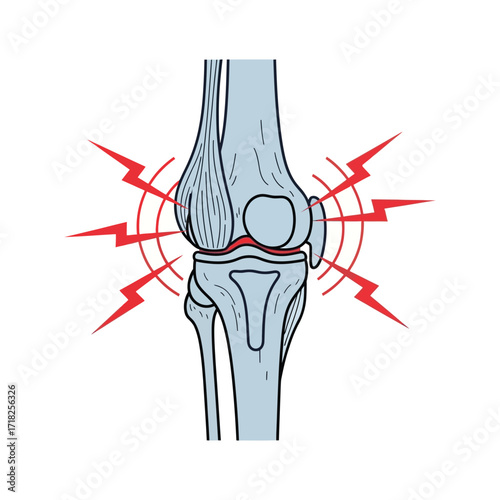 Illustration of a human knee joint experiencing pain and inflammation