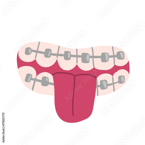Icon of teeth with braces. Mouth with orthodontic tool. Happy smile with sticking tongue. Dental health, oral hygiene. Stomatology and dentistry. Flat isolated vector illustration on white backgroun