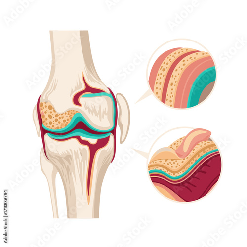 Detailed knee joint anatomy illustration showcasing bone structure, cartilage, and ligaments for medical education and patient information resources