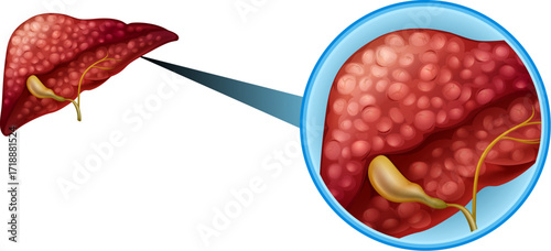 Liver Cirrhosis Medical Diagram – Fibrosis, Damage & Disease Visualization