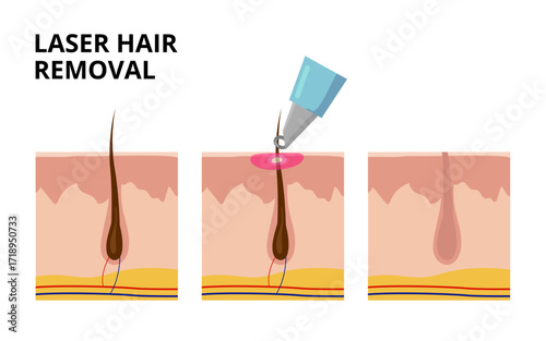 Laser hair removal treatment destroying hair follicle under skin