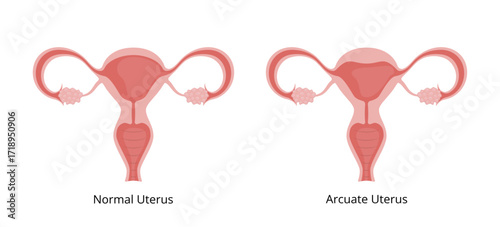 Normal Uterus and Arcuate Uterus Comparison Showing Female Reproductive System Anatomy