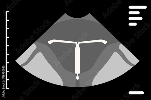 Ultrasound showing intrauterine device placed in uterus