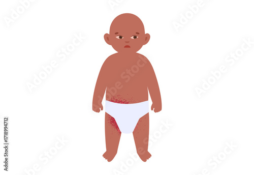 Diaper rash poster