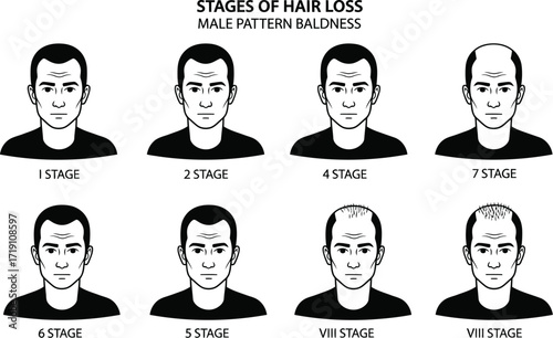Male pattern baldness stages hair loss treatment information editable vector