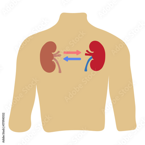 kidney transplant 