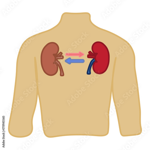 kidney transplant 