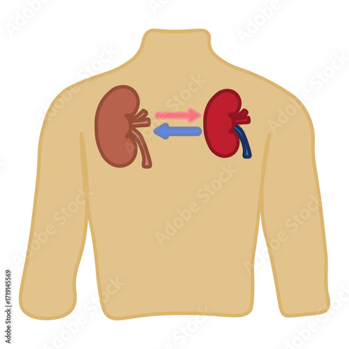 kidney transplant 