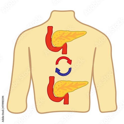 Pancreas Transplant Medical Icon