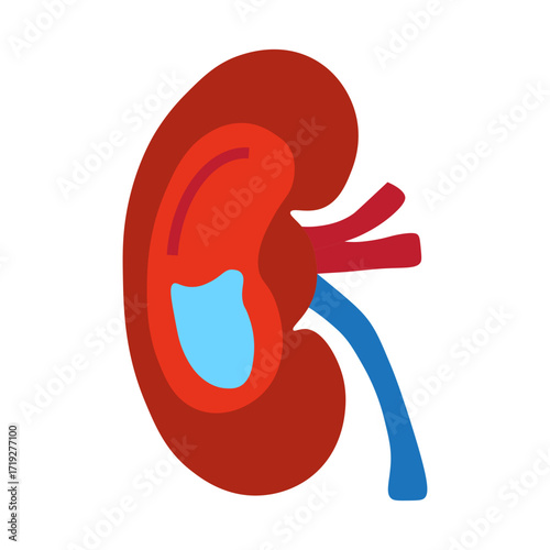 Hydronephrosis