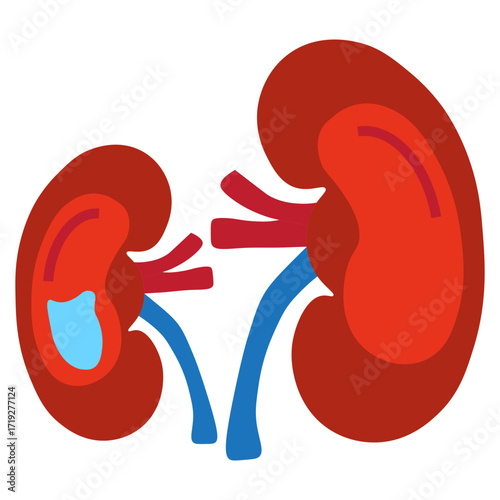 Hydronephrosis