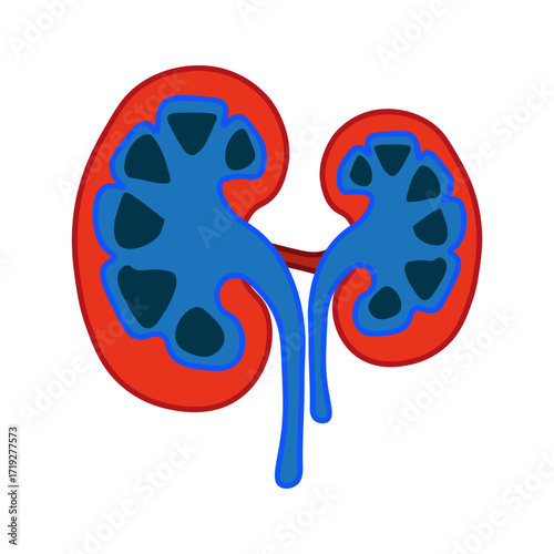 Hydronephrosis