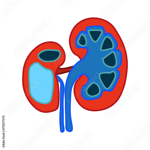 Hydronephrosis