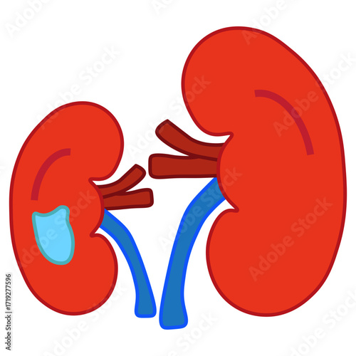 Hydronephrosis
