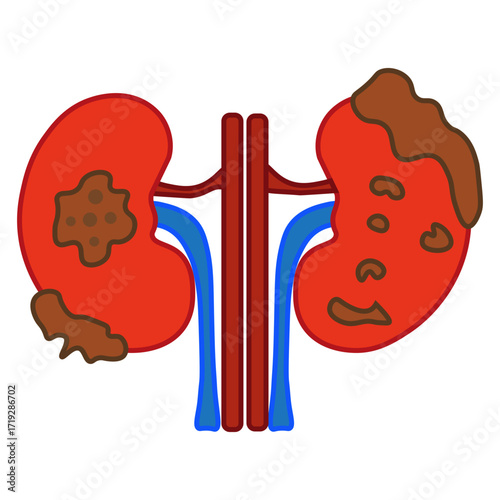 kidney cancer