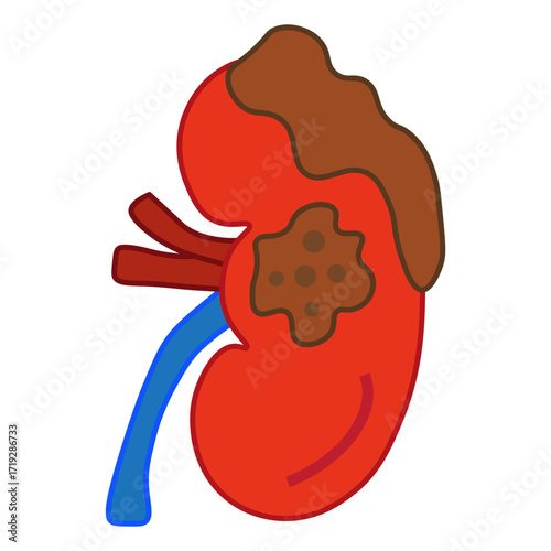 kidney cancer