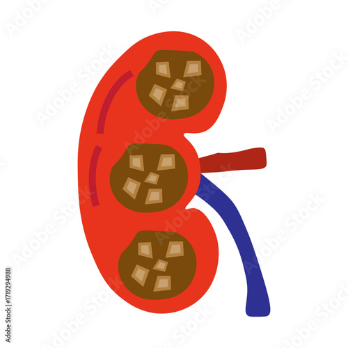 chronic kidney stone disease