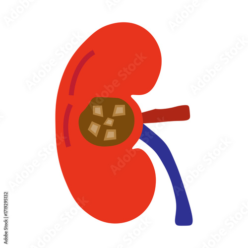 chronic kidney stone disease