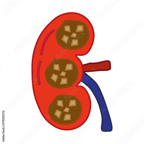 chronic kidney stone disease