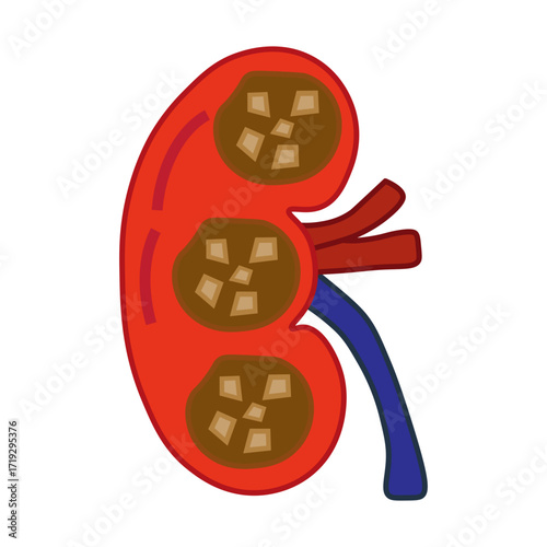 chronic kidney stone disease