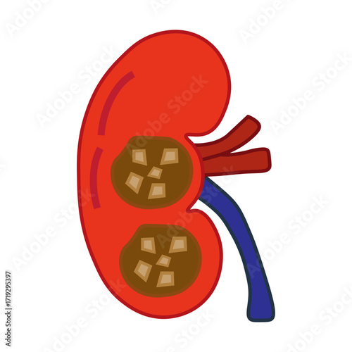 chronic kidney stone disease