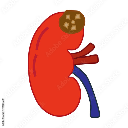 chronic kidney stone disease