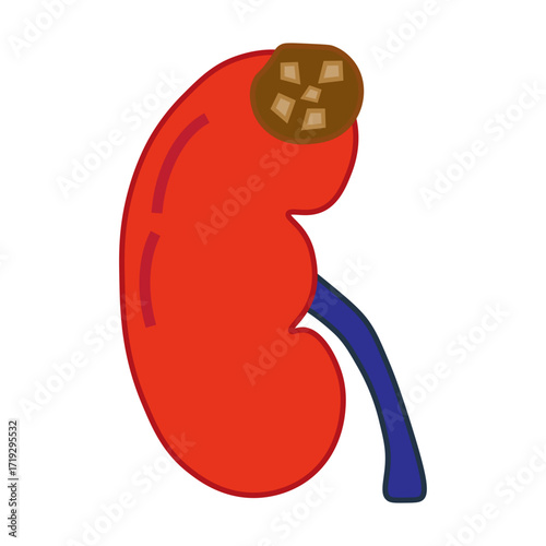 chronic kidney stone disease