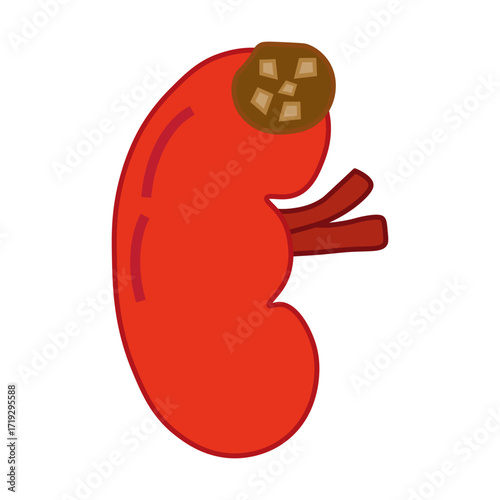 chronic kidney stone disease