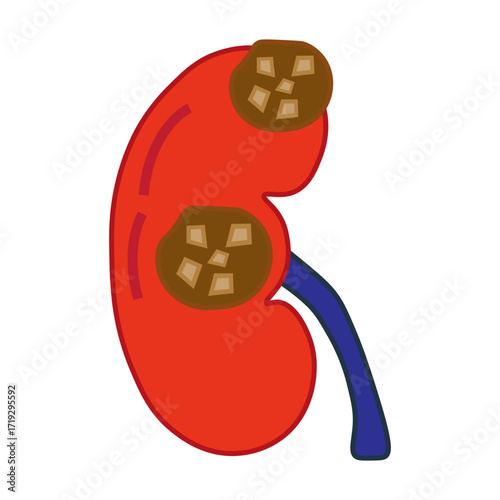 chronic kidney stone disease