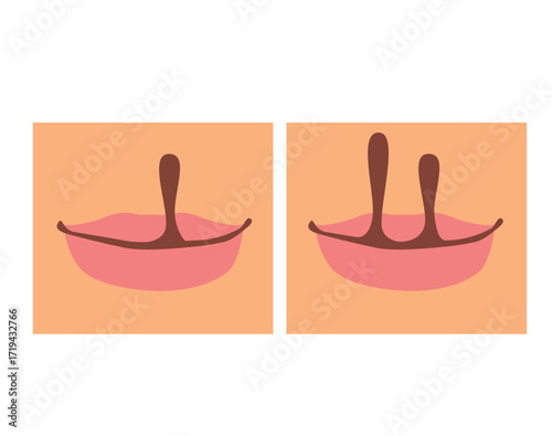 Cartoon illustration showing a close up infographic representation of cleft lip and palate, unilateral and bilateral types on skin background. Medical, educational and healthcare purposes content