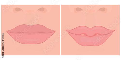 Korean Cupid plastic surgery or lip tip plastic surgery. Vector illustration.