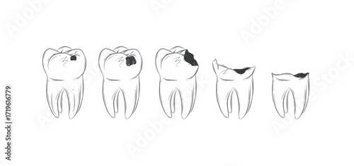 Life cycle of dental caries illustration drawing in graphic style with black on white background.