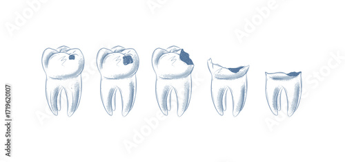 Life cycle of dental caries illustration drawing in graphic style with blue on white background.