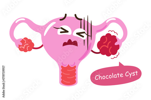 Endometriosis or chocolate cyst . Uterus cartoon character illustration . Isolated white background . Vector .
