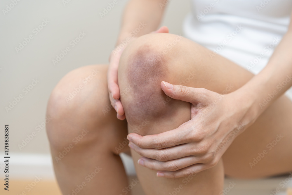Φωτογραφία Close up of stain bruise wound on leg, contusion asian young woman, girl on joint knee from an accident fell down, hand in healing injury by massage hematoma blood