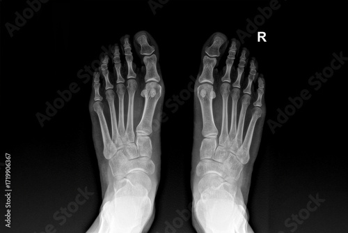 X-ray image of human feet showing bones, joints, toes and skeletal structure, useful for medical, healthcare, orthopedics, podiatry, anatomy, diagnostics, fracture examination and radiology education 