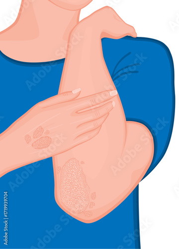 Human body problem. Psoriasis treatment. Elbow and hand.ai