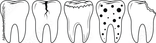 Illustration of the stages of tooth decay, showing the progression from a healthy tooth to a cracked, decayed, cavitated, and chipped tooth