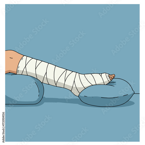 A leg in a plaster cast on pillows, elevated to reduce swelling, is a detailed illustration for doctors and patients.