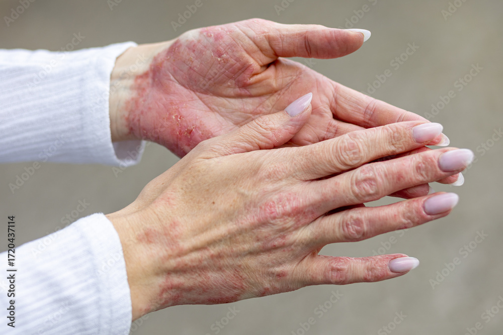 Fototapeta premium Hands showing eczema and psoriasis symptoms during a peaceful outdoor gathering on a sunny day in a park setting