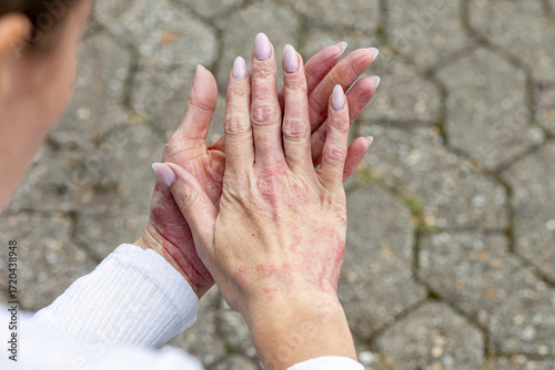 Skin condition on hands with visible eczema and psoriasis affecting daily life in an outdoor setting